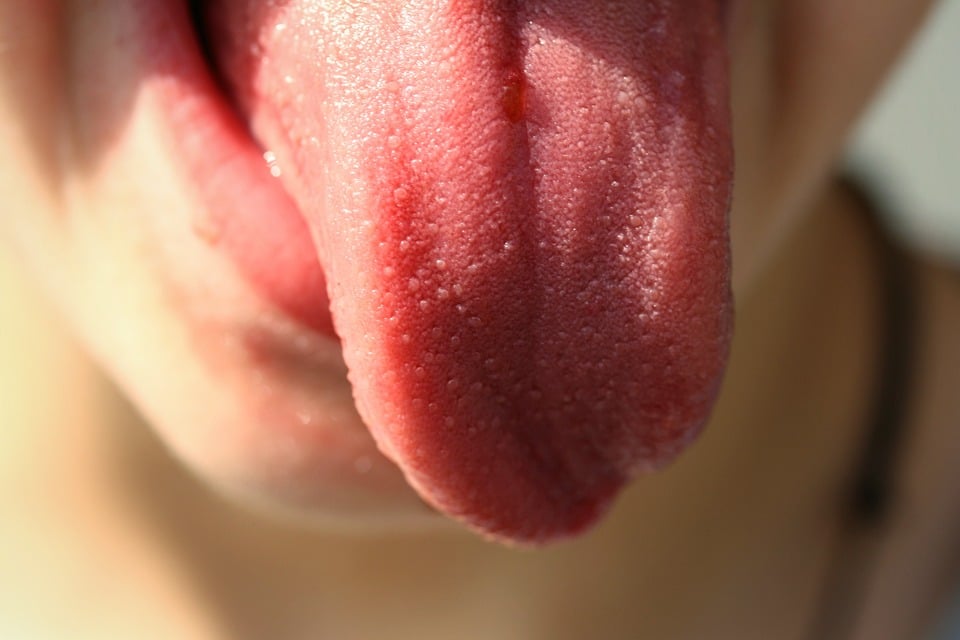 Pathology Outlines  Hairy tongue